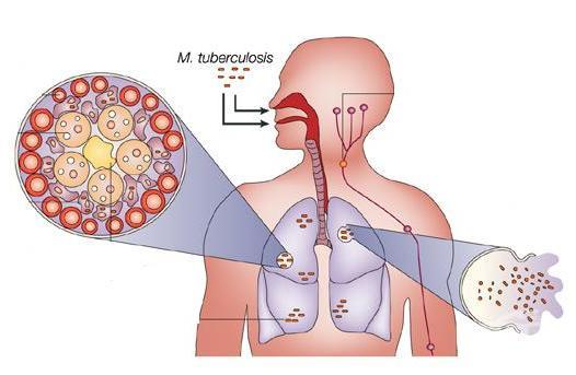 tuberculosis_lymph_nodols.jpg